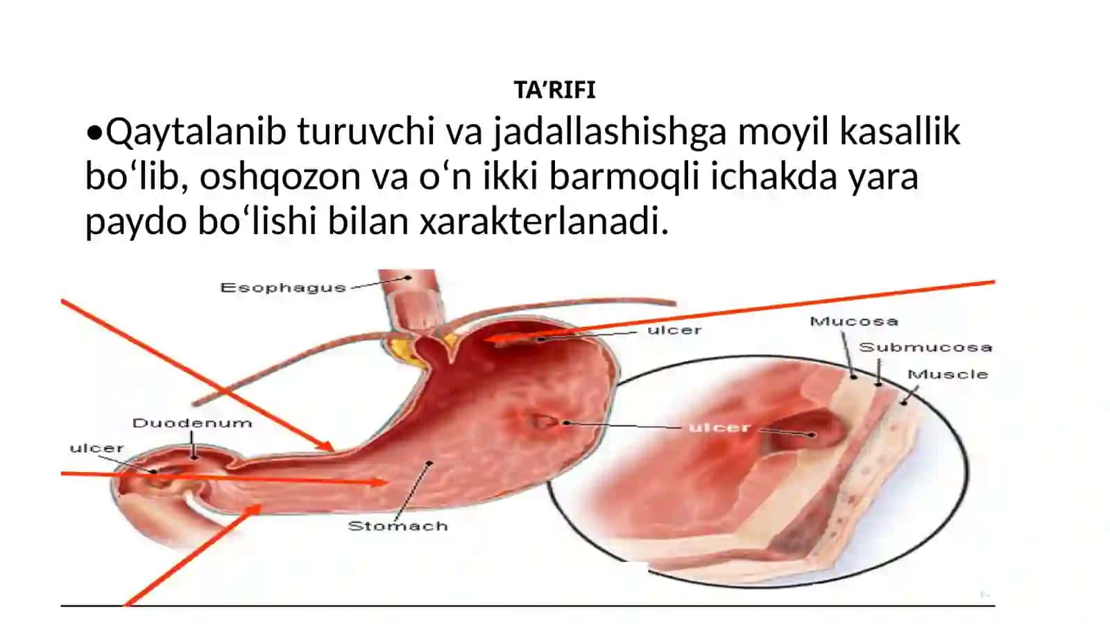 Oshqozonvao‘nikkibarmoqliichakyarakasalligi 2