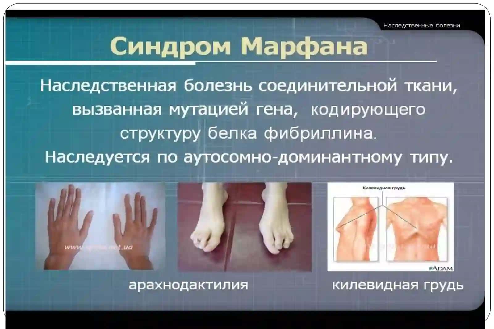 Наследственные болезни с нарушением соединительной ткани и скелета 2