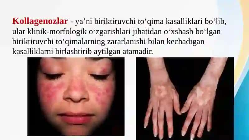 Kollagenozlar, patogenozi va tashxisi. Glikozaminoglikanlar tibbiyotda qo’llanilishi 2