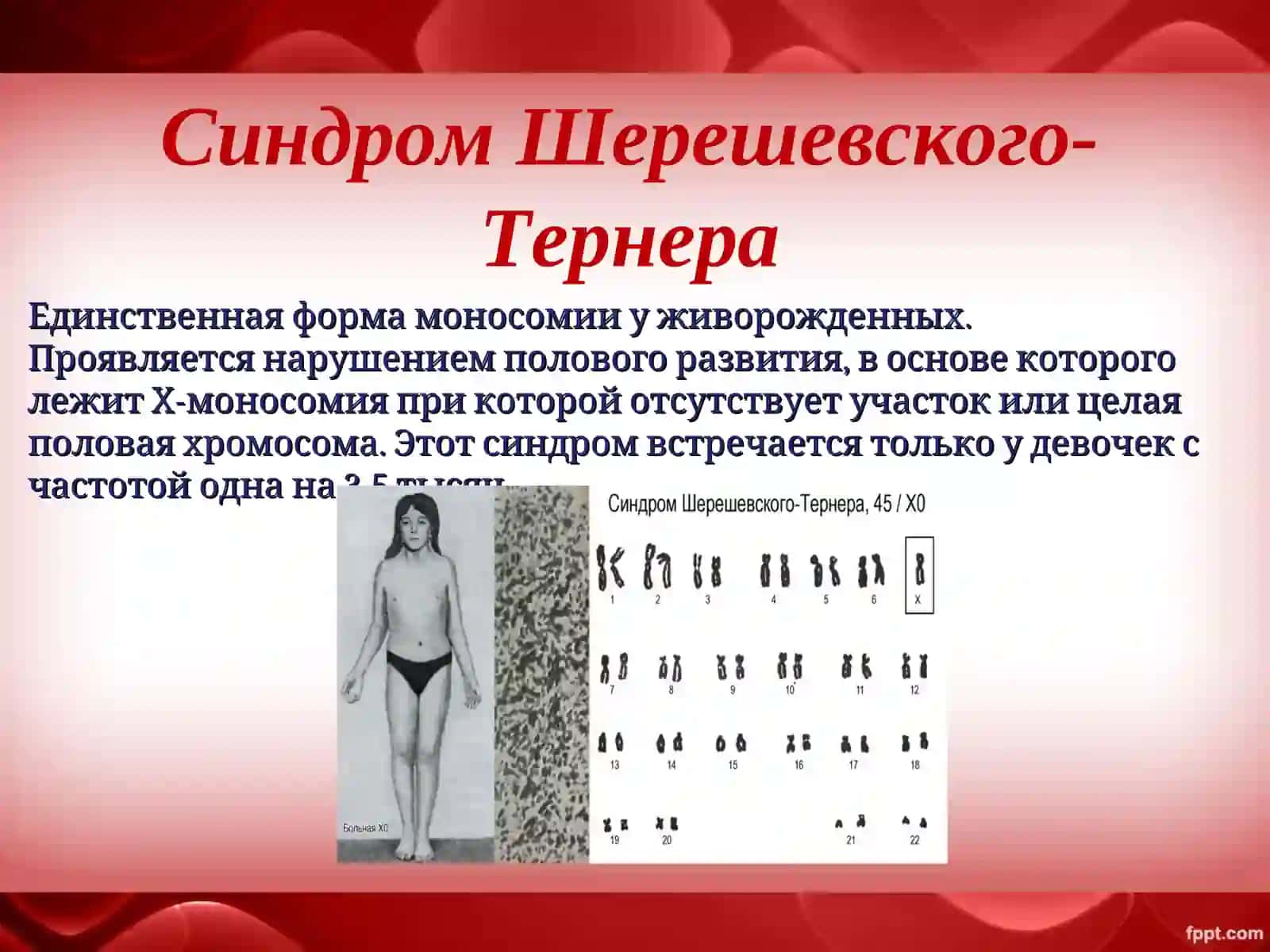 Синдром Шерешевского-Тернера 2