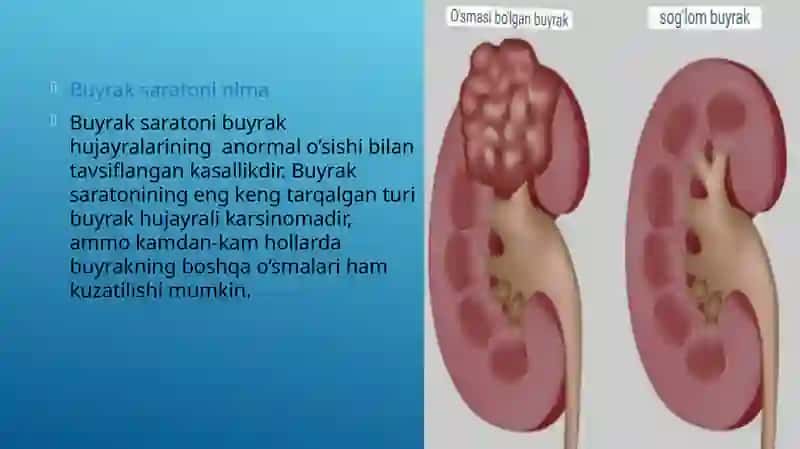 Buyrak saratonining tavsiflanishi 2