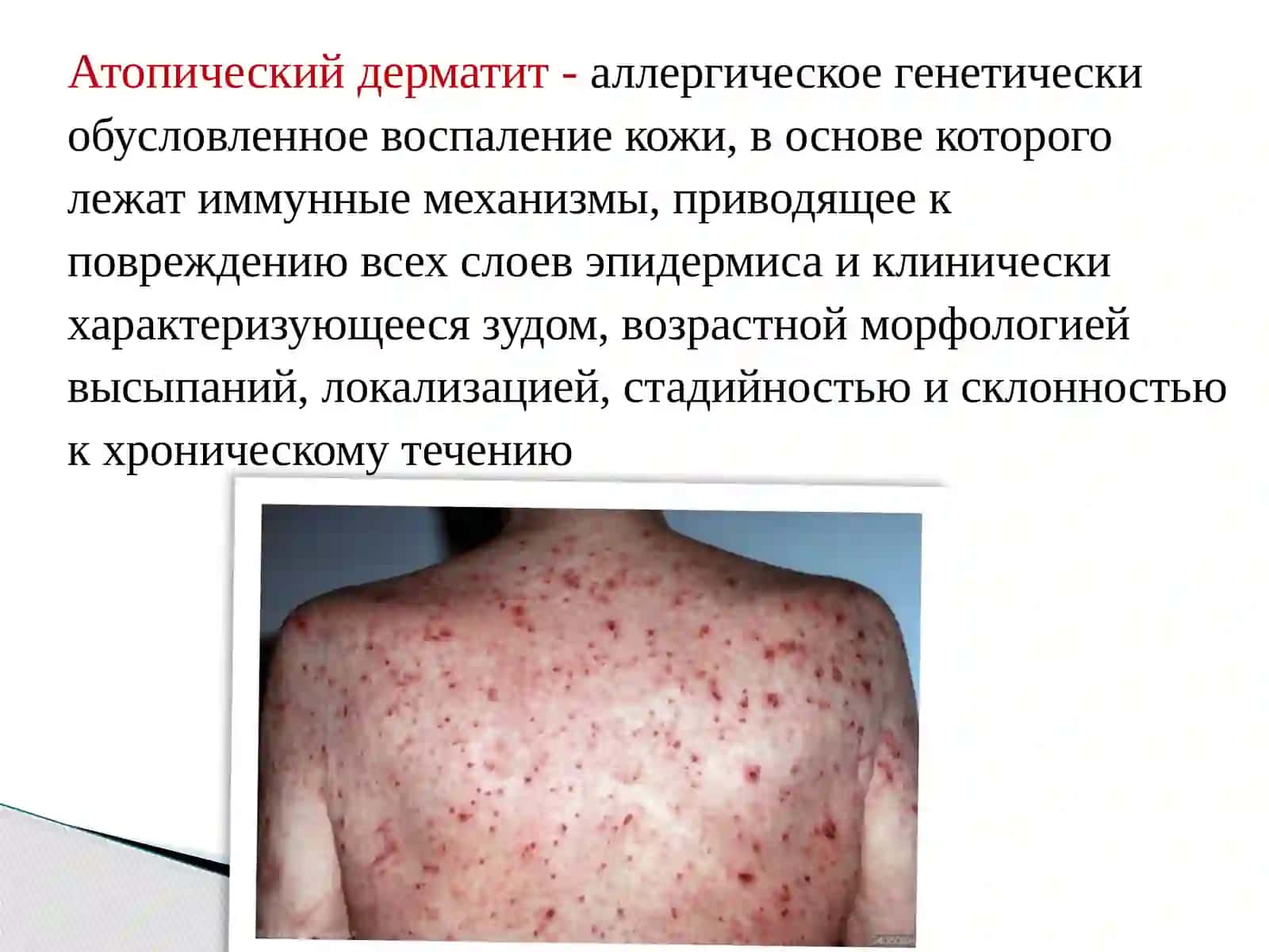 Атопический дерматит 2