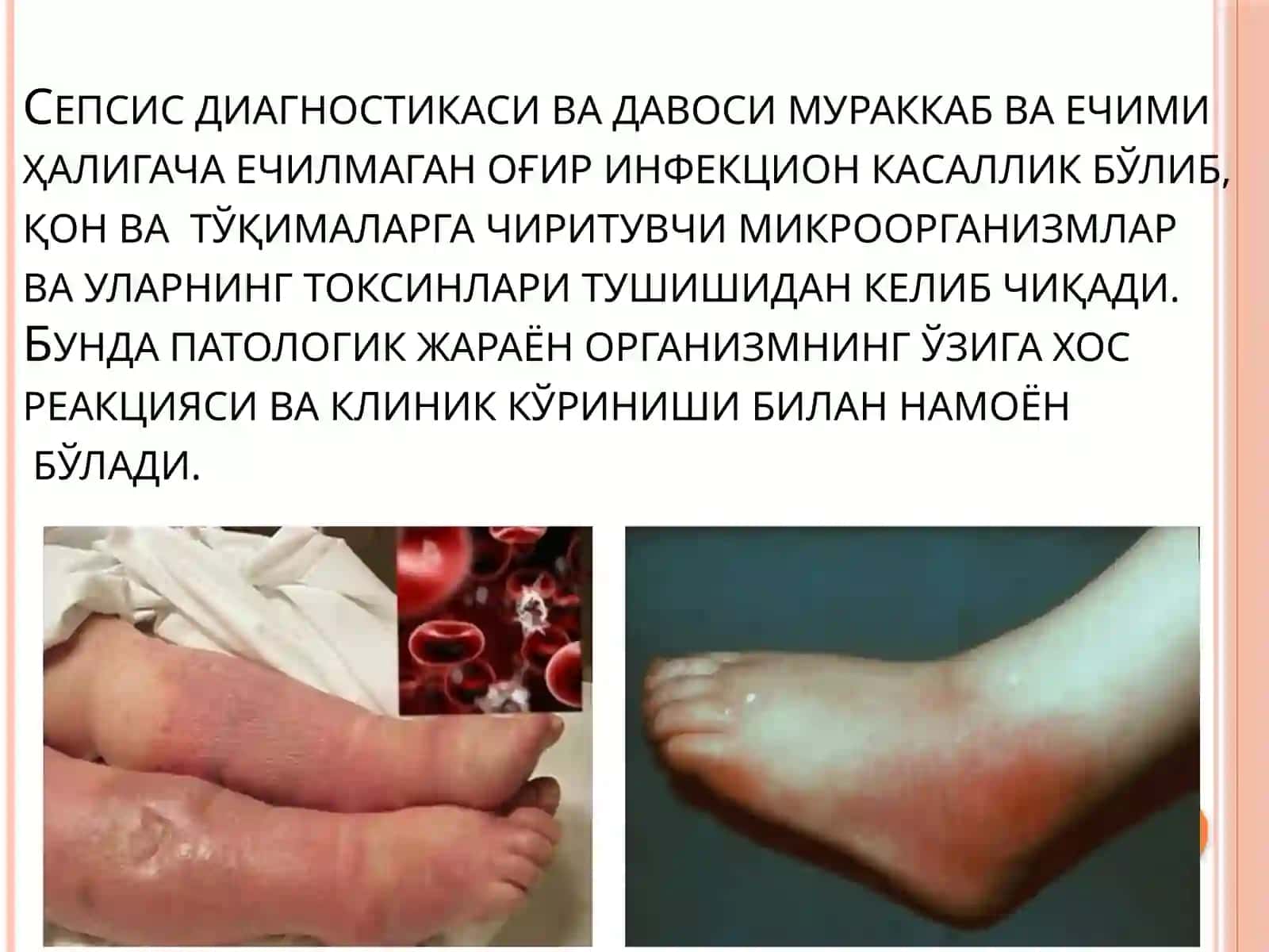 Сепсиснинг замонавий таснифи 2