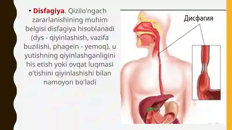 Disfagiya 2
