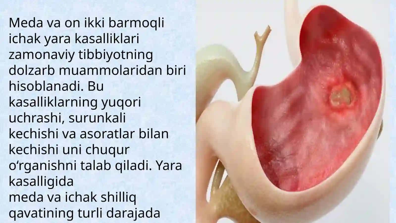 Me'da yara kasalligi etiologiyasi, patogenezi, klinikasi asoratlari, davolash usullari 2