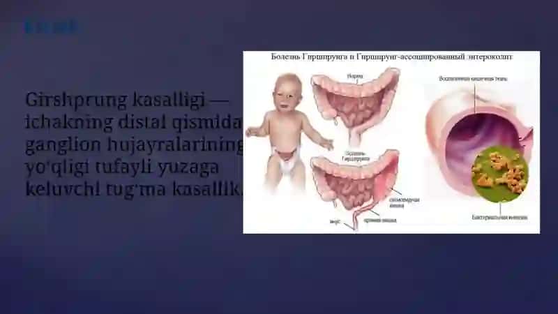 Megakolon va Grishprung kasalligida operatsiyalar 2