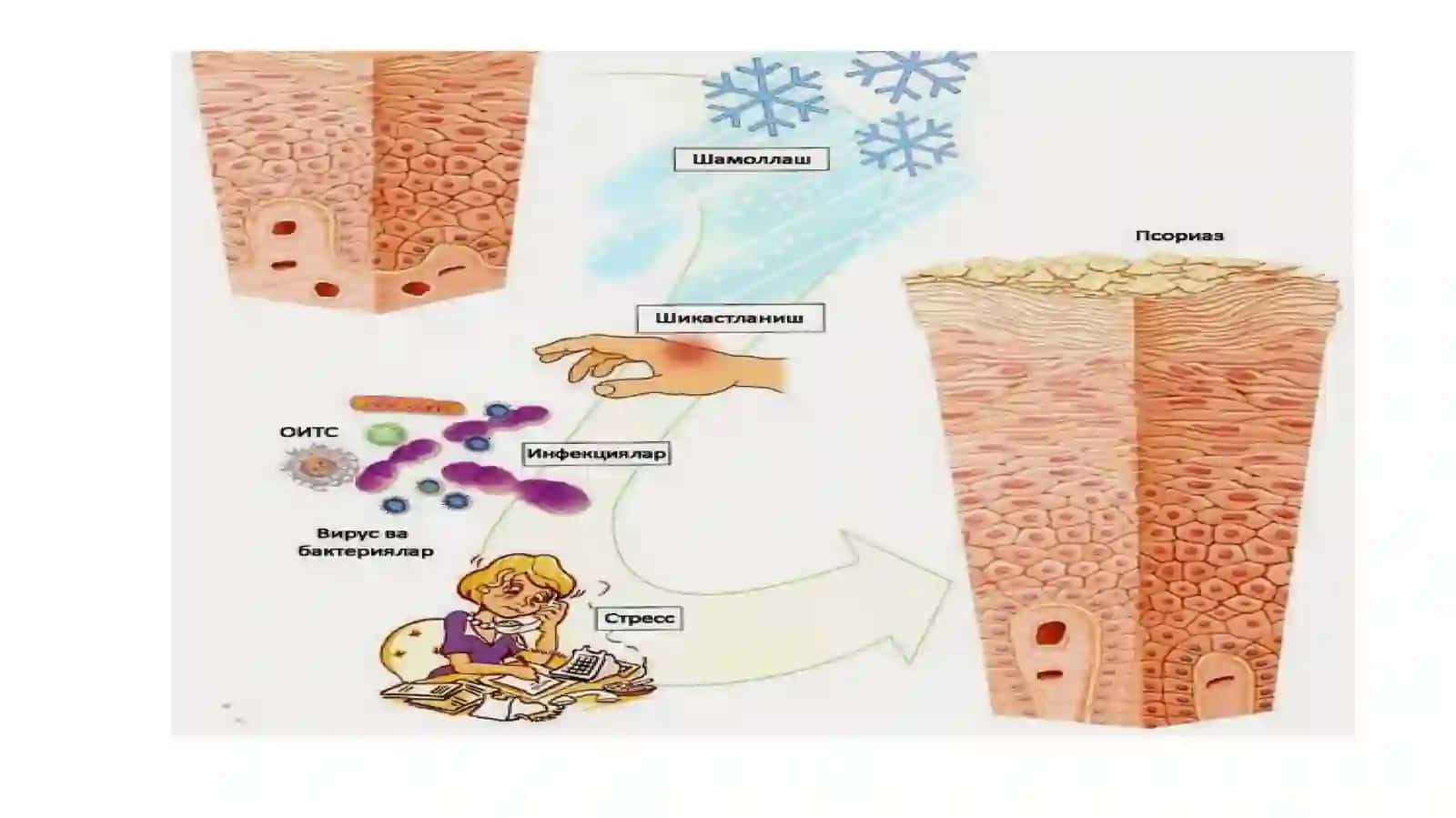 JIBERNING PUSHTI RANGLI TEMIRATKISI (PITYRIASIS ROSEA GIBERT) 2