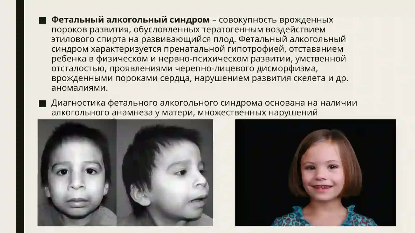 Фетальный алкогольный синдром. (Симптомы и Причины) 2