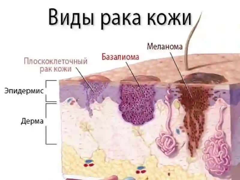 Рак кожи 2