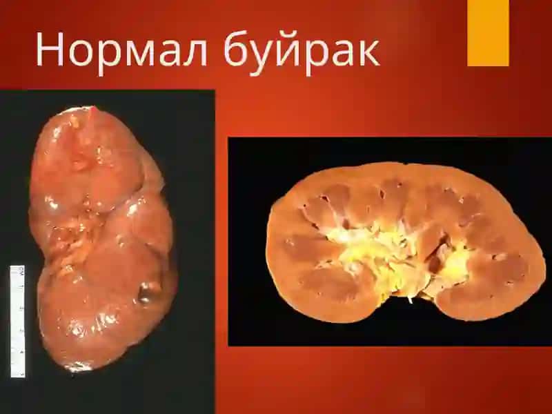 БУЙРАК КАСАЛЛИКЛАРИ 2