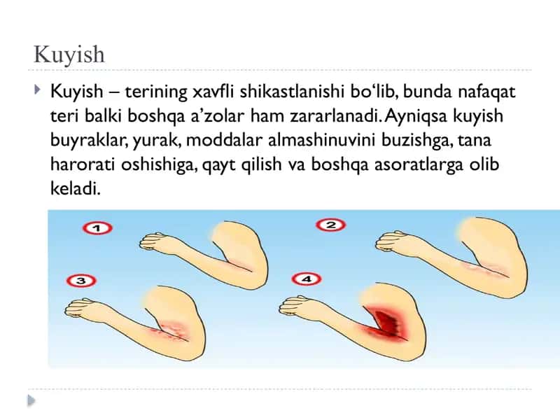 Ochiq jarohatlar, kuyish va sovuq urish 2
