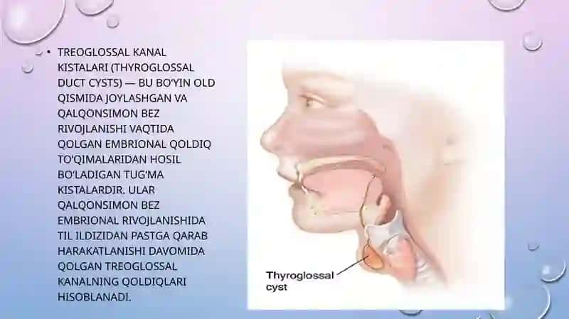 Treoglossal kanal kistalari 2