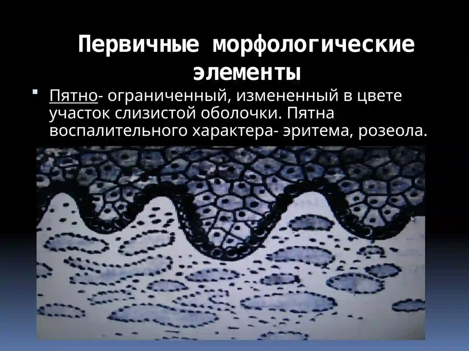 Заболевания слизистой оболочки и мягких тканей полости рта 2
