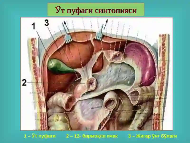 Ўт тош касаллиги. Холециститлар, диагностикаси ва даволаш 2