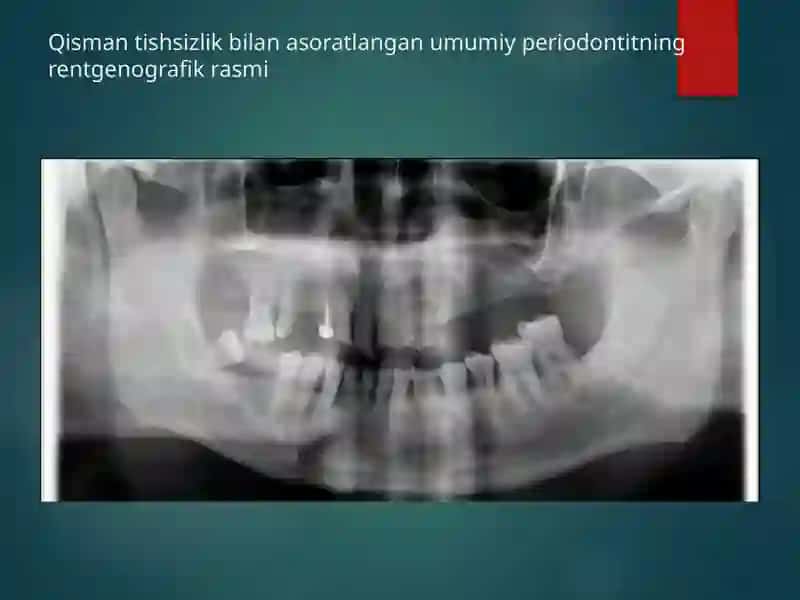 Kombinatsiyalangan travmatik okklyuzion 2