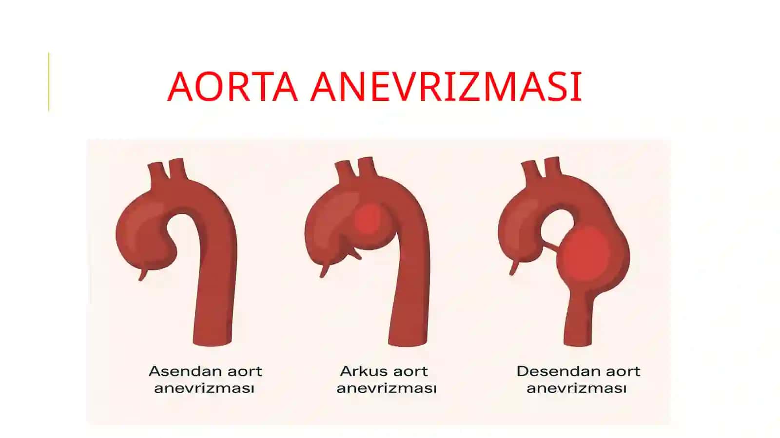 AORTA ANEVRIZMASI 2