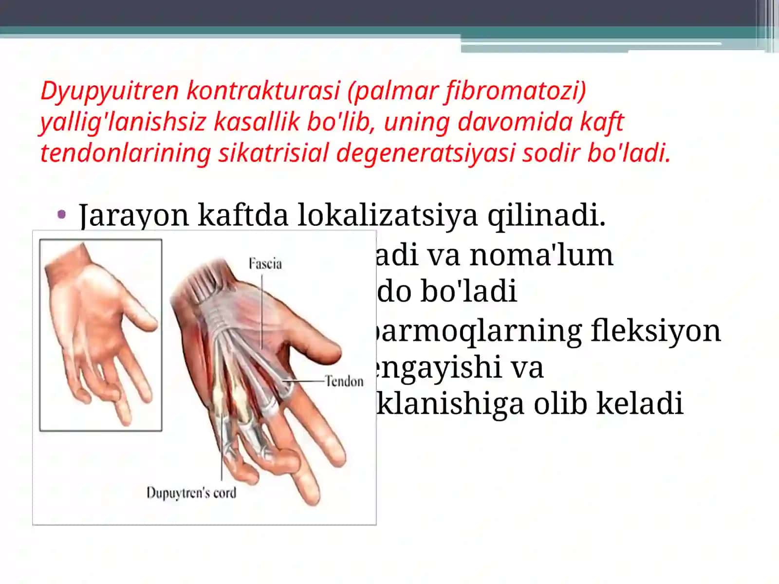 Dyupyuitren kontrakturasi 2