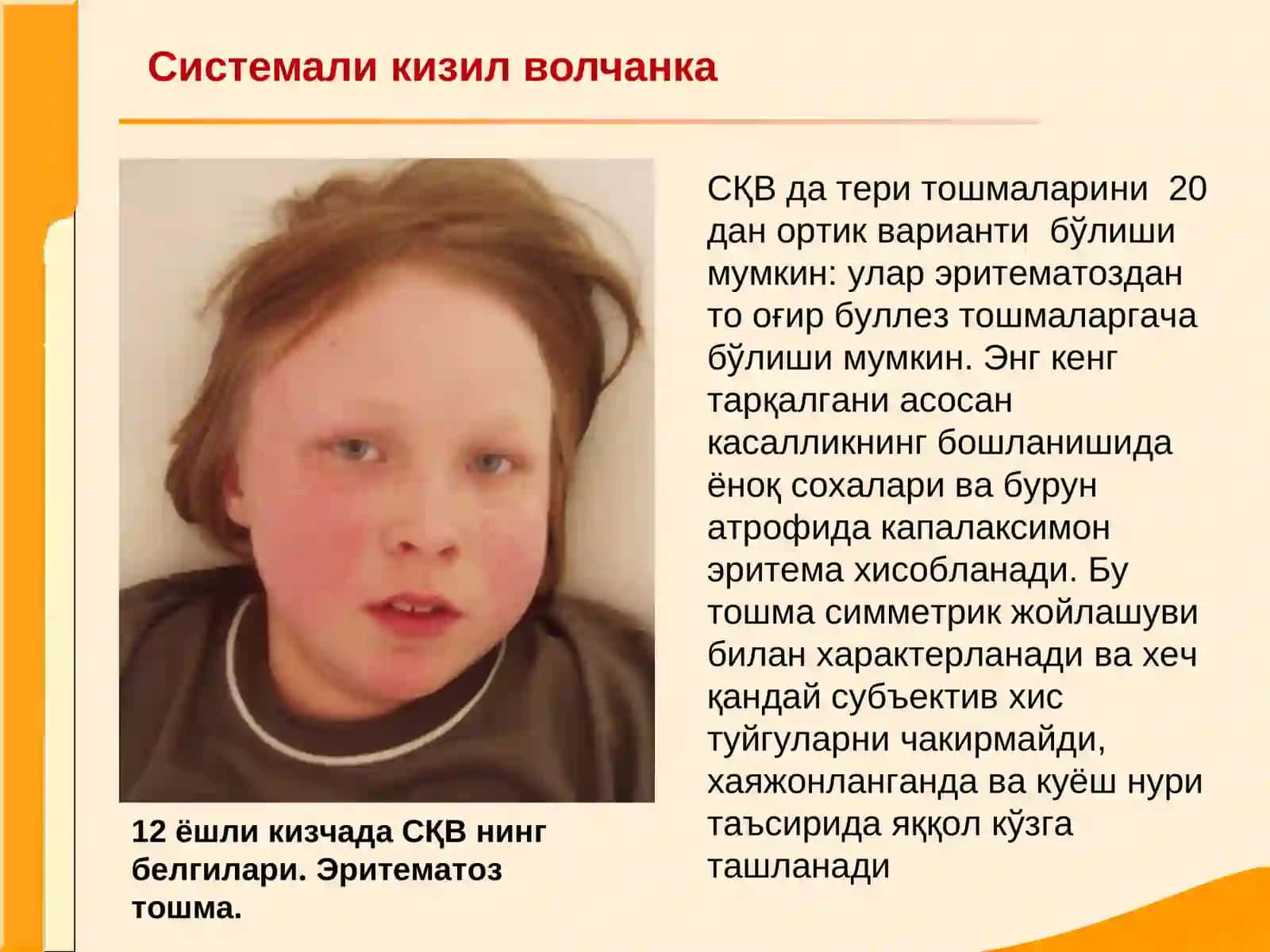 Системали кизил волчанка 2