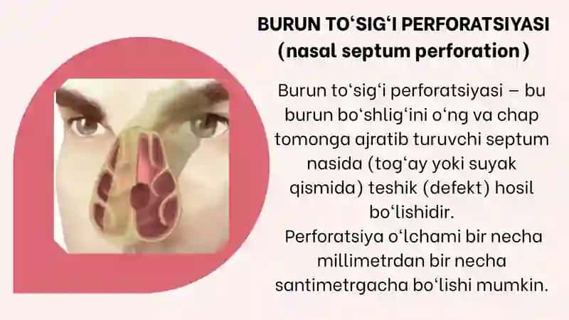 Burun TO'SiG'I Perforatsiyasi Sabablari va Davolash 2