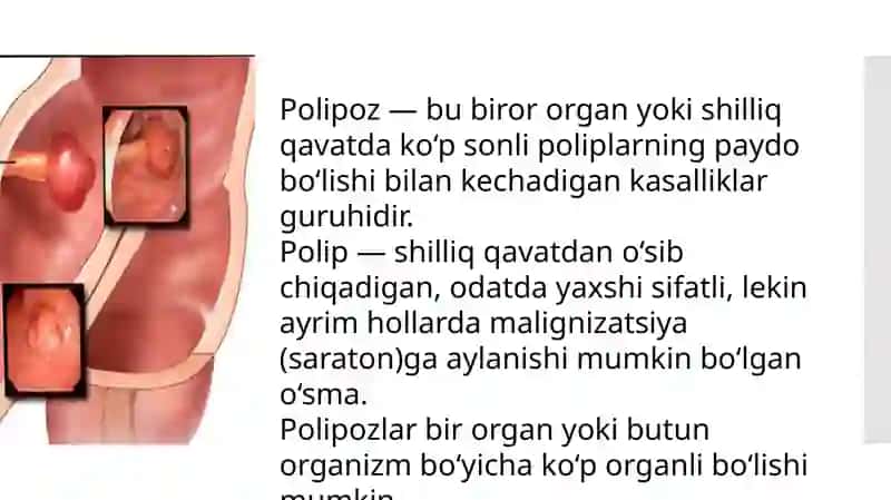 Polipozlar 2