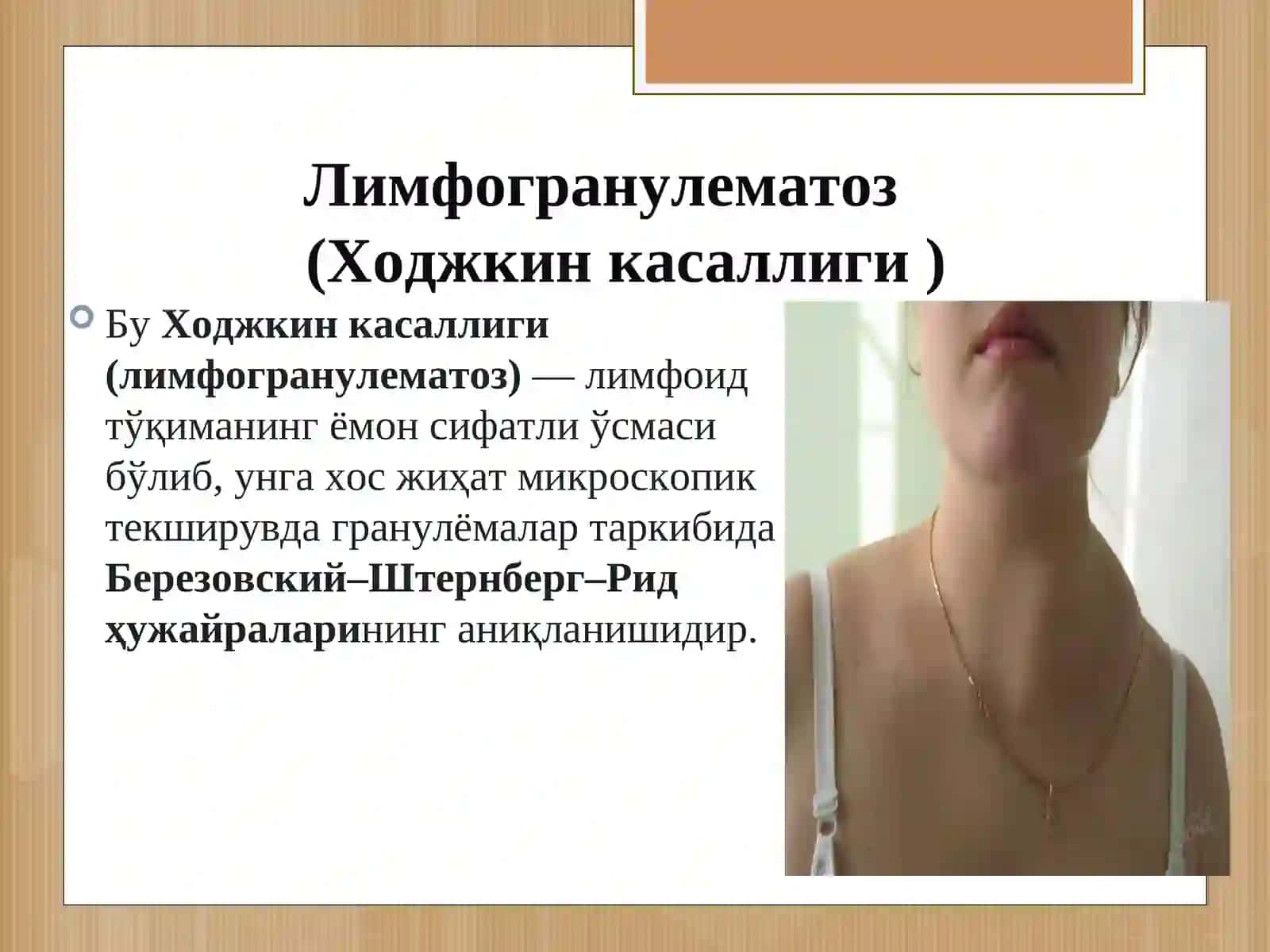 Лимфогранулематоз (Ходжкин касаллиги ) 2