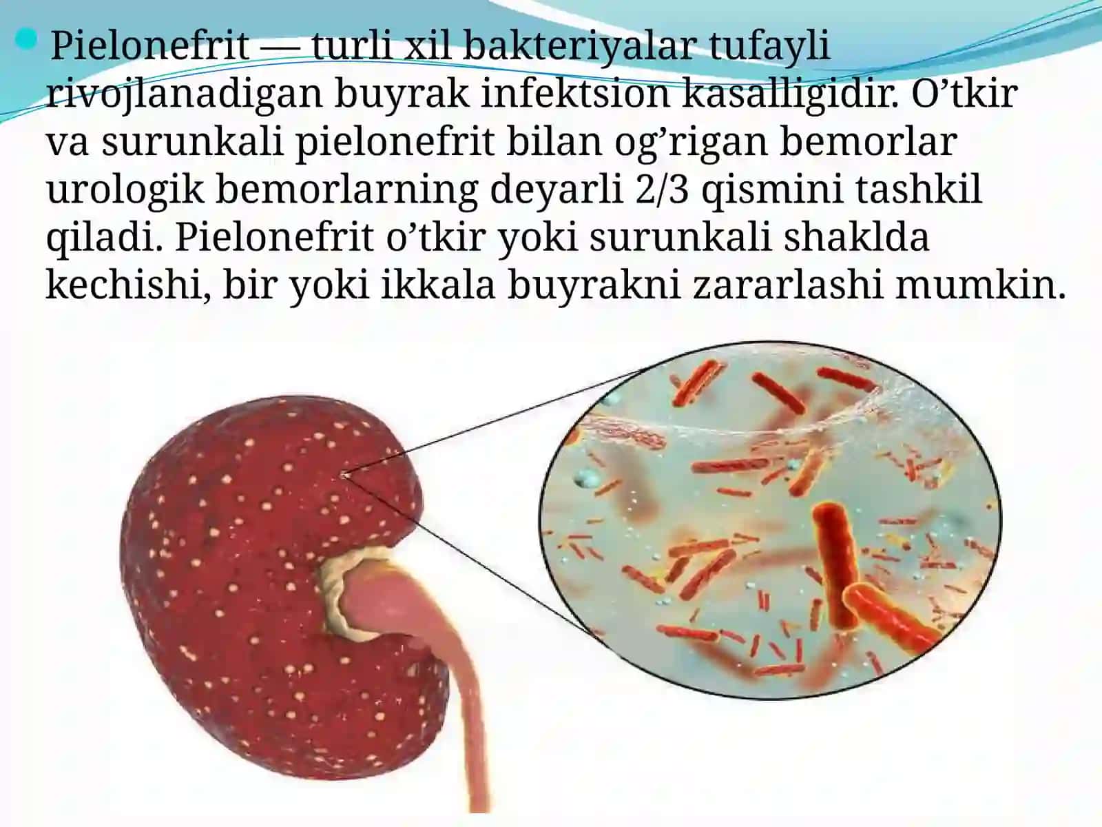 O`tkir va surunkali piyelonefrit. Simptomlari, asoratlari va davolash yo`llari 2