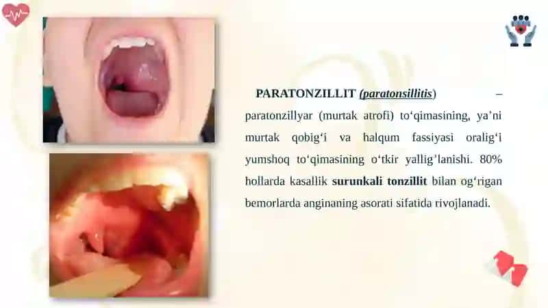 PARATONZILIT VA 8- TISH PEREKORONIT BILAN DIFFERENSIAL TASHXISLASH 2