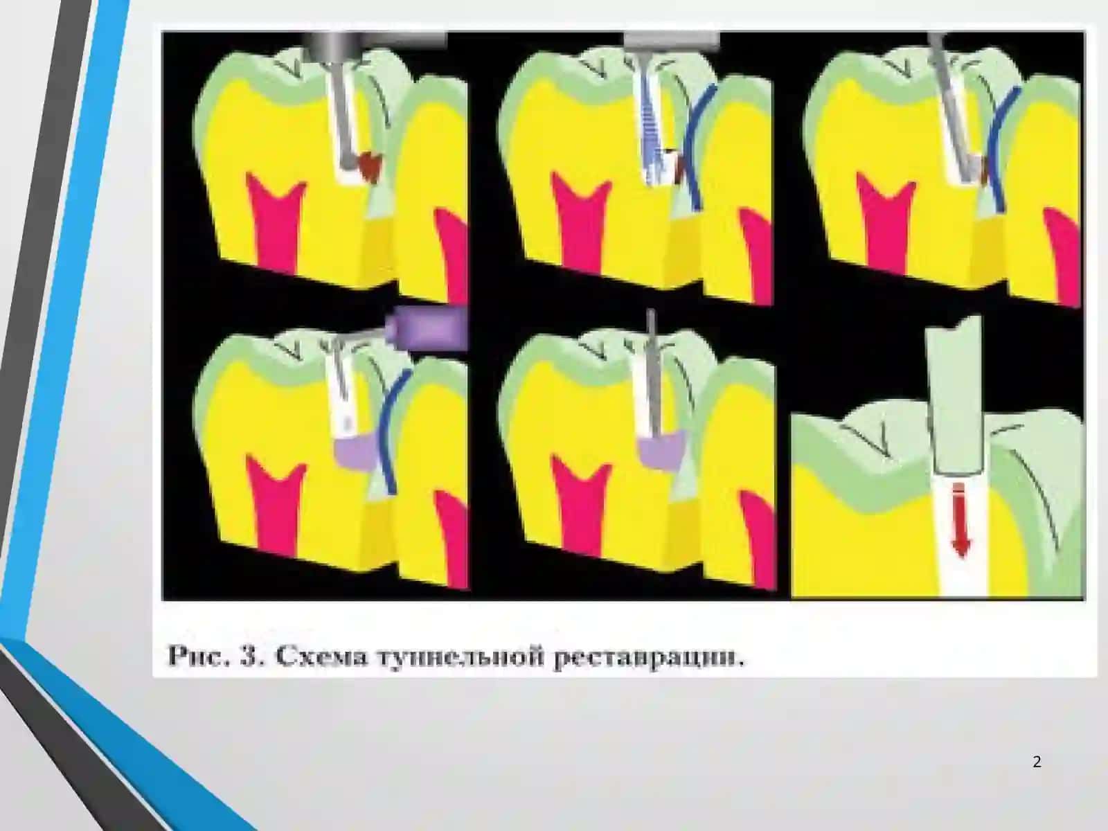 Tunnelli charxlash usuli 2