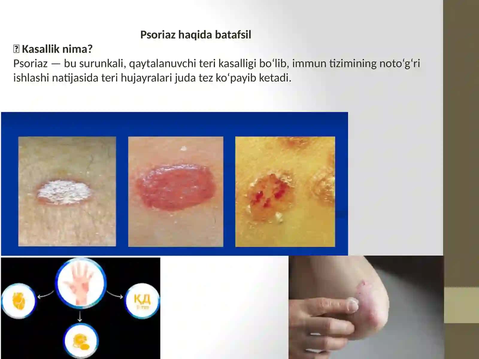 Psoriaz.Bemorlarni professional ko'rikdan o'tkazish. 2