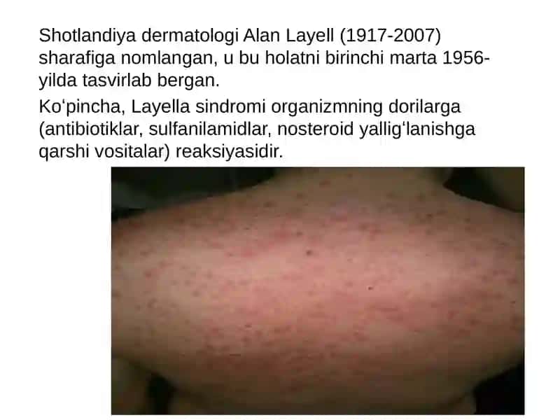 Layella sindromi (SindromLayella) 2