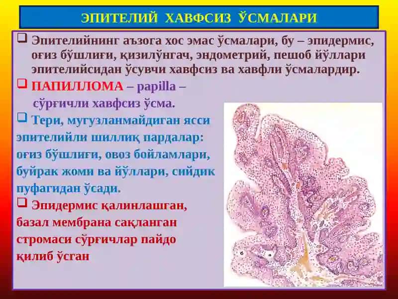 ПАТОЛОГИК АНАТОМИЯ “Ўсмалар. Мезенхимал ўсмалар” 2