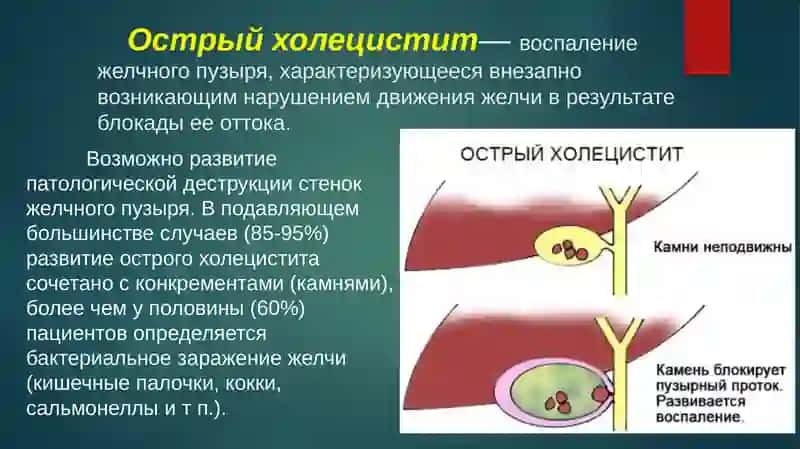 Холецистит 2
