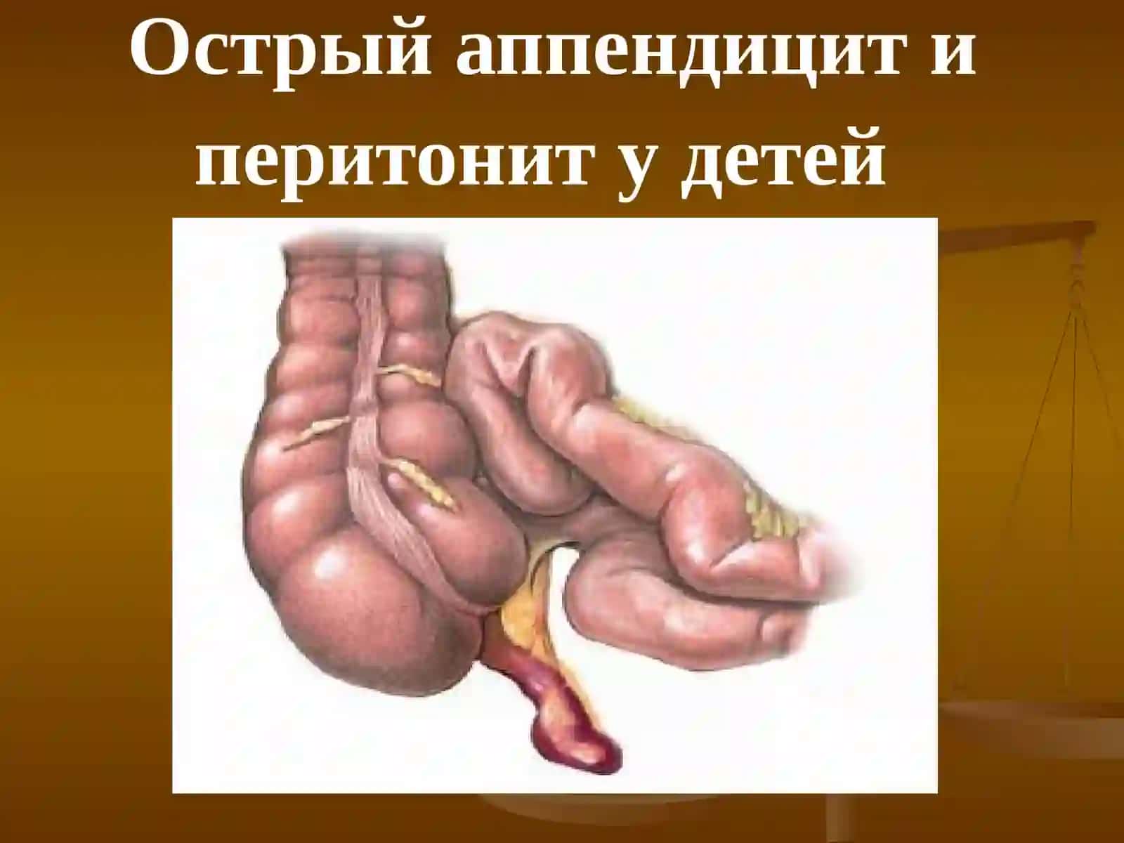 Гнойно-воспалительные заболевания брюшной полости у детей. Острый аппендицит и перитонит у детей 2