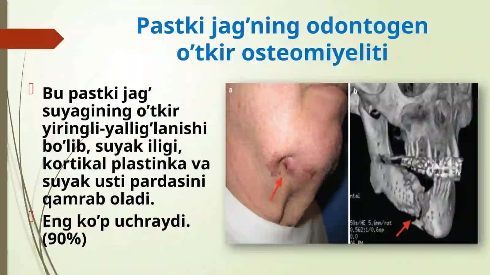 Pastkijag’ning tanasivash o'xidagi kechayot g'an o'tkirosteomiyeliti 2