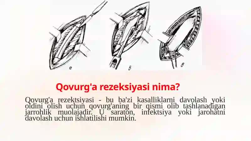 Qovurg'alar rezektsiya qilish texnikasi 2