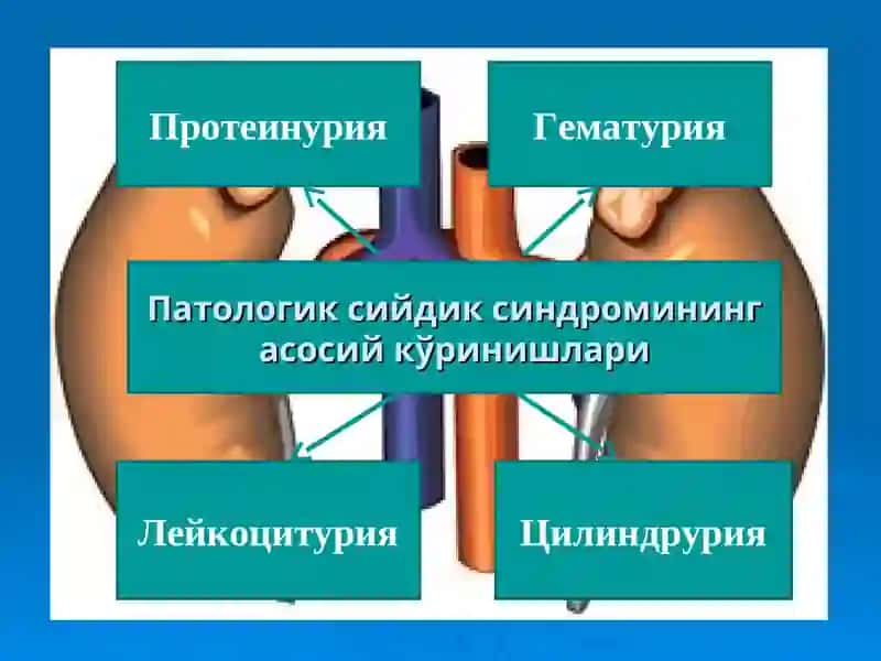Сийдик чўкмасидаги ўзгаришлар билан кечадиган касалликлар 2