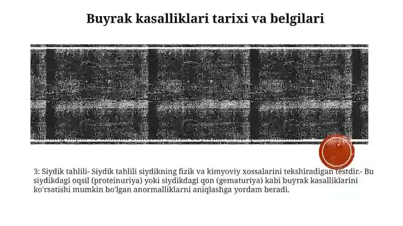 Buyrak Kasalligi Bilan Kasallangan Bemorlarni Tekshirish 2