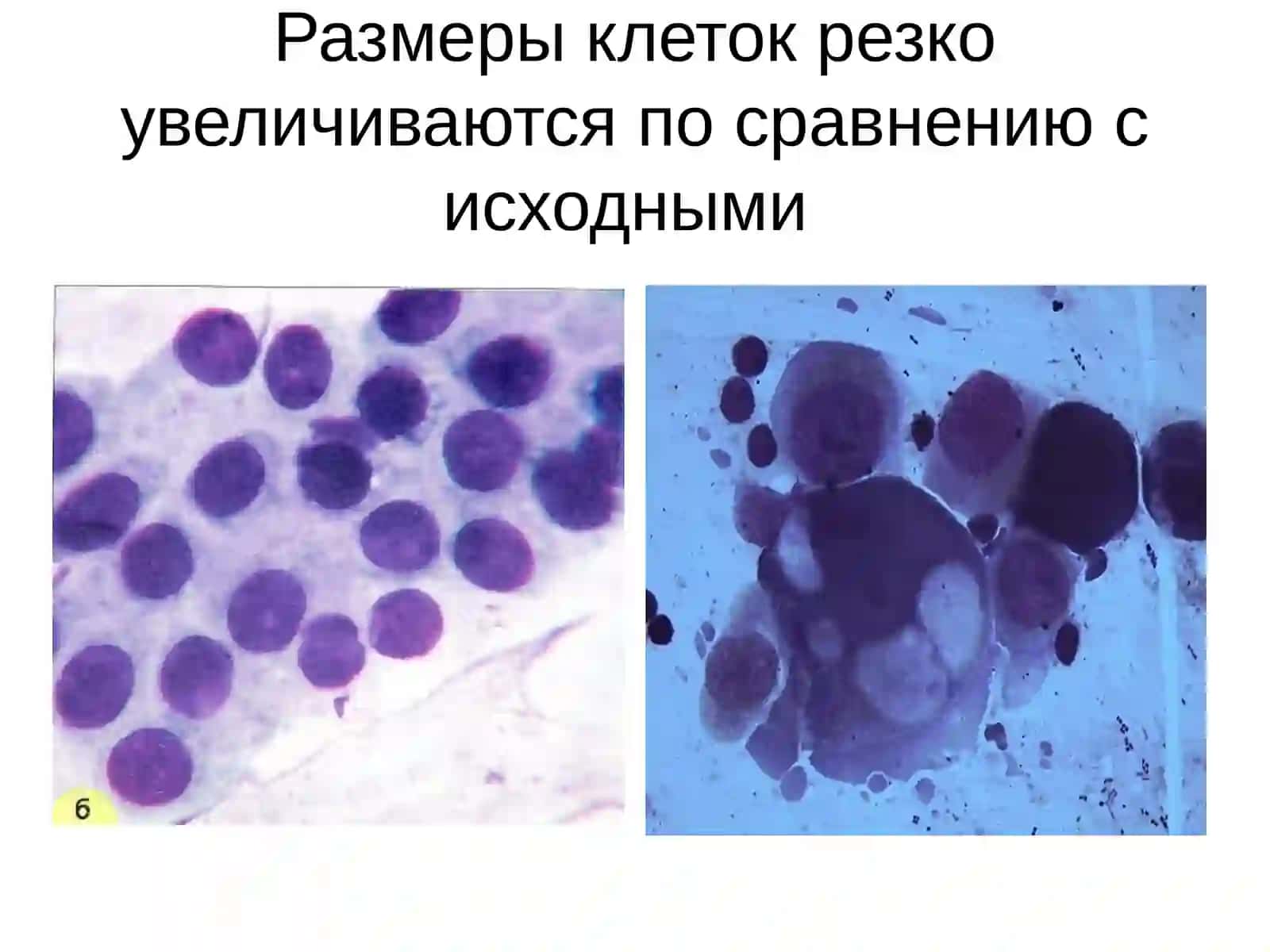 Определение злокачественности клеточных элементов 2
