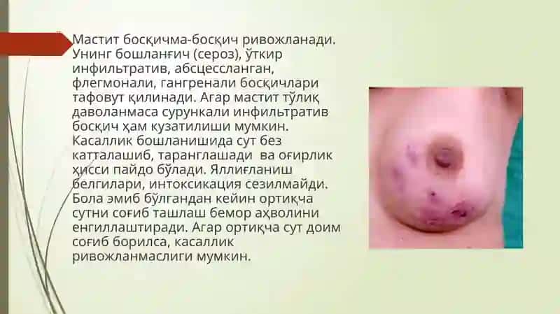 Мастит-Сутбези 2