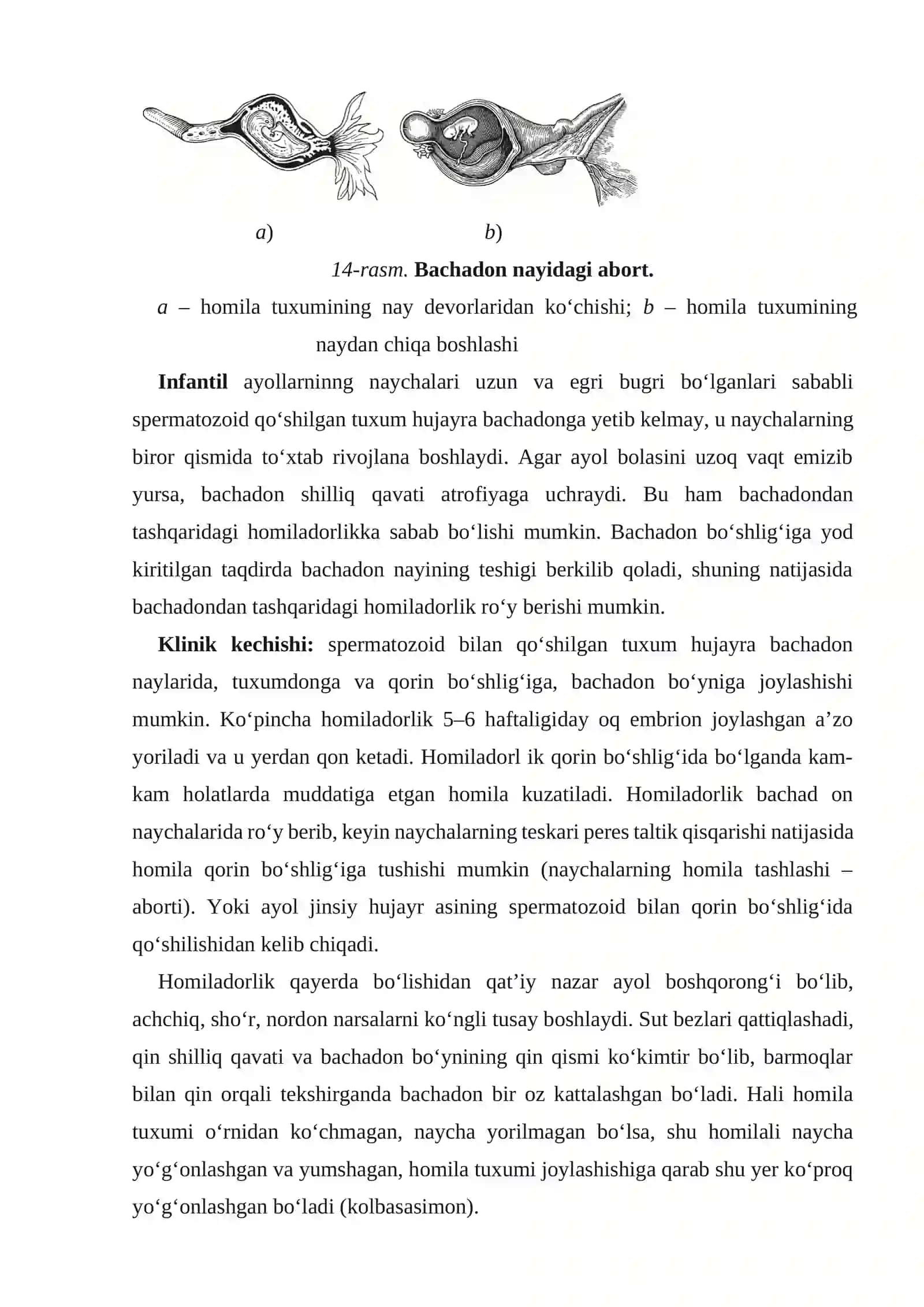 Bachadondan tashqaridagi homiladorlik (graviditas extrauterina) 2