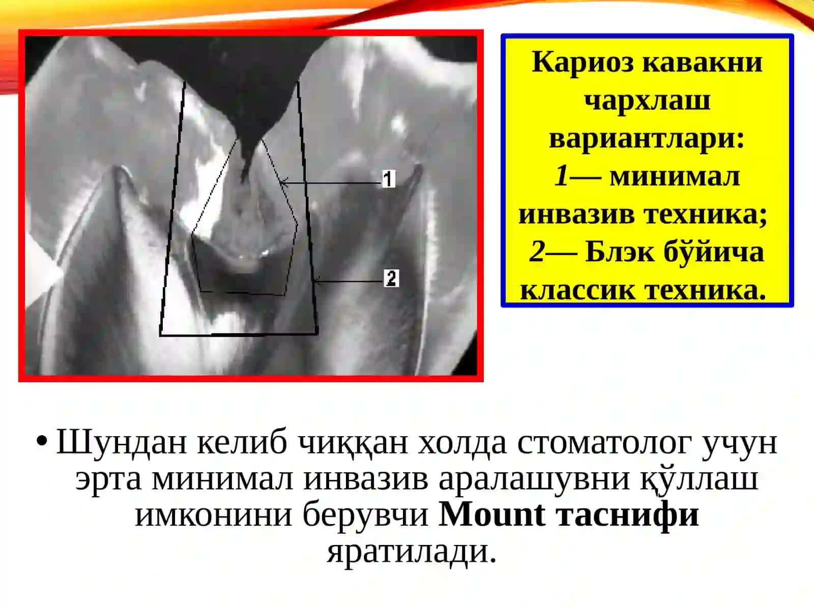 МИНИМАЛ ИНВАЗИВ ДАВОЛАШ(MIT—minimalinterventiontreatment) 2