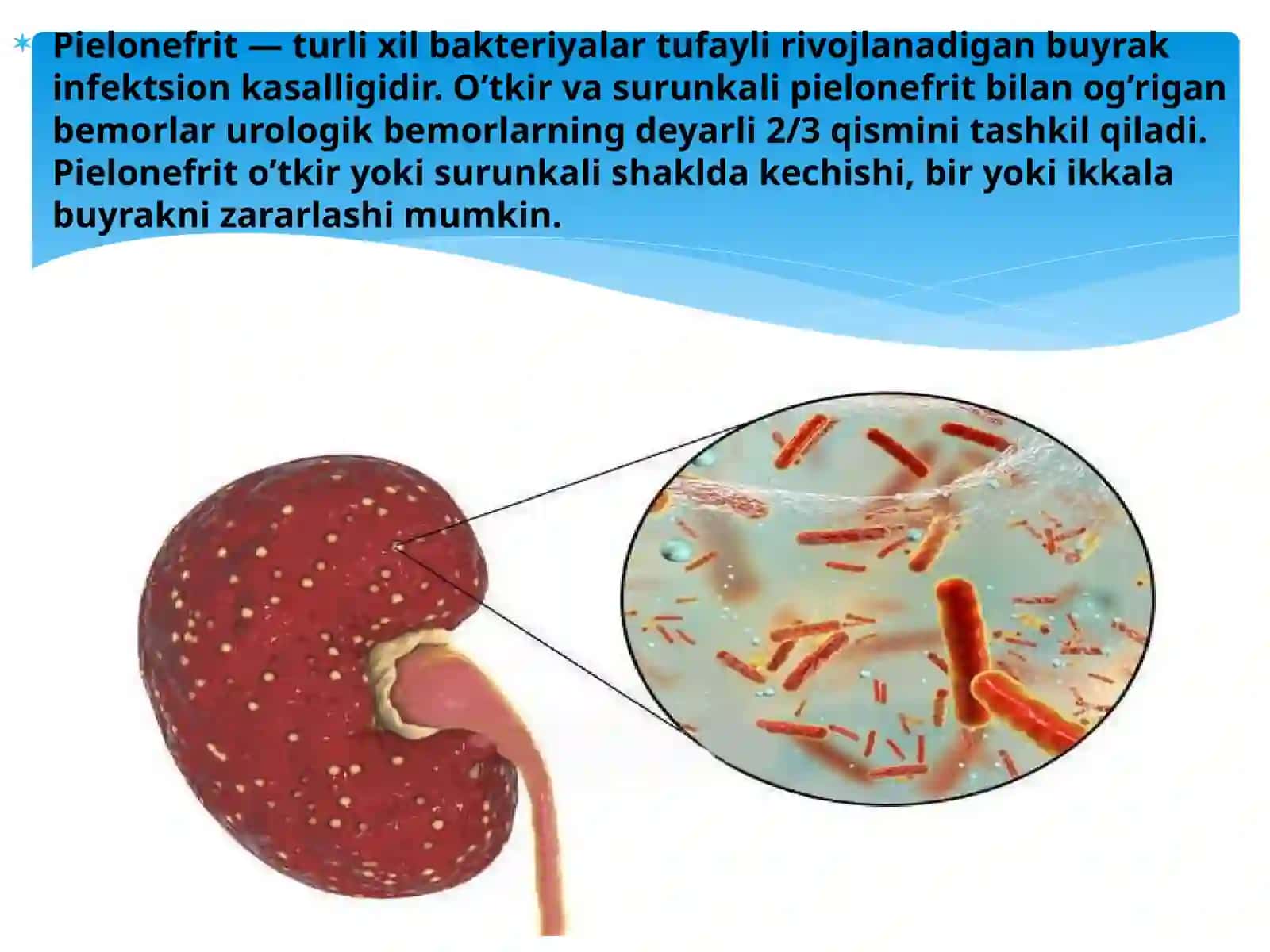 O`tkirvasurunkalipiyelonefrit.Simptomlari,asoratlarivadavolashyo`llari 2