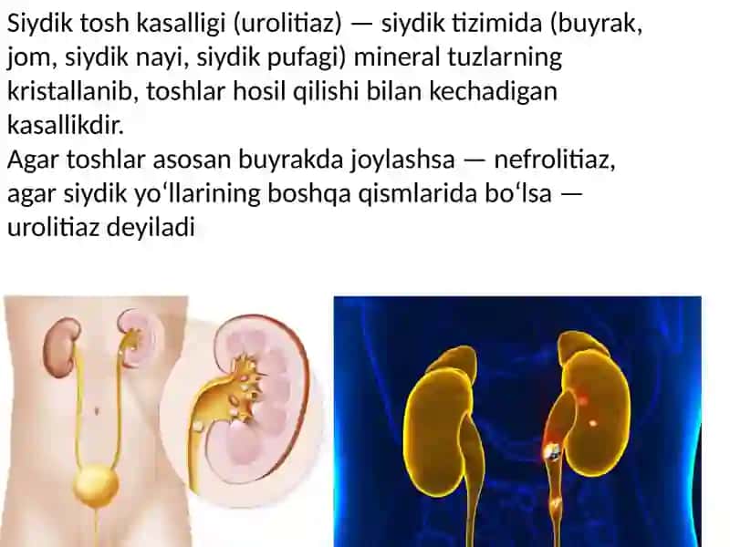 Buyrakda tosh hosil boʻlishi sabablari va mexanizmlari 2