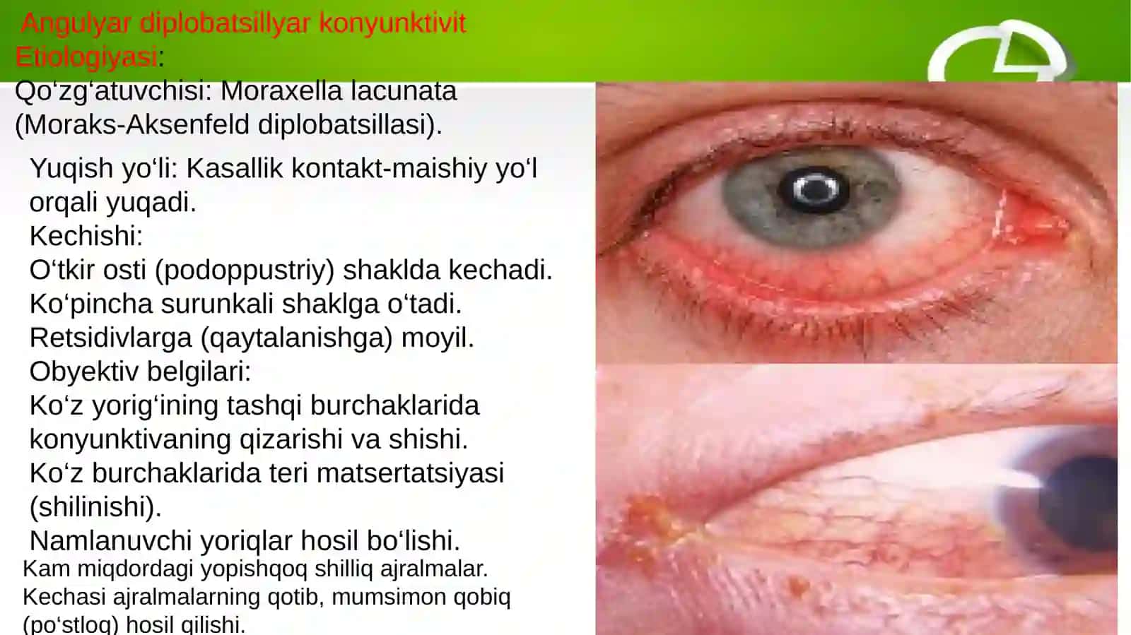 Angulyar diplobatsillyar konyunktivit 2