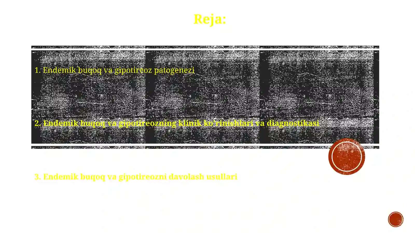 Endemik buqoq va gipotireoz patogenezi va davolash usullari 2