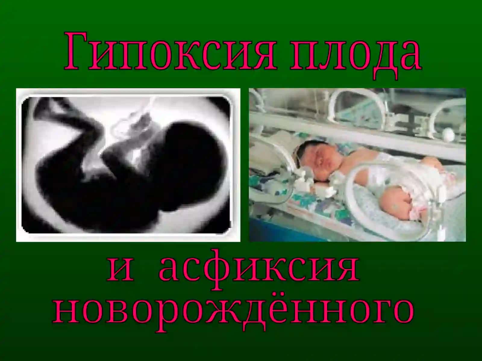 Внутриутробная гипоксия плода (hypoxia fetus) 2