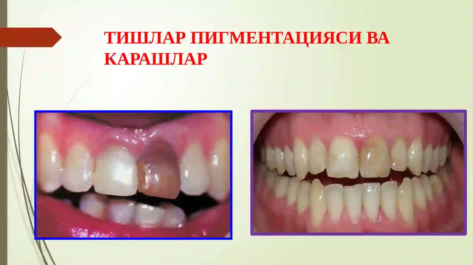 Тишларни оқартириш. Кўрсатма ва қарши кўрсатмалар. Қўллаш услублари 2