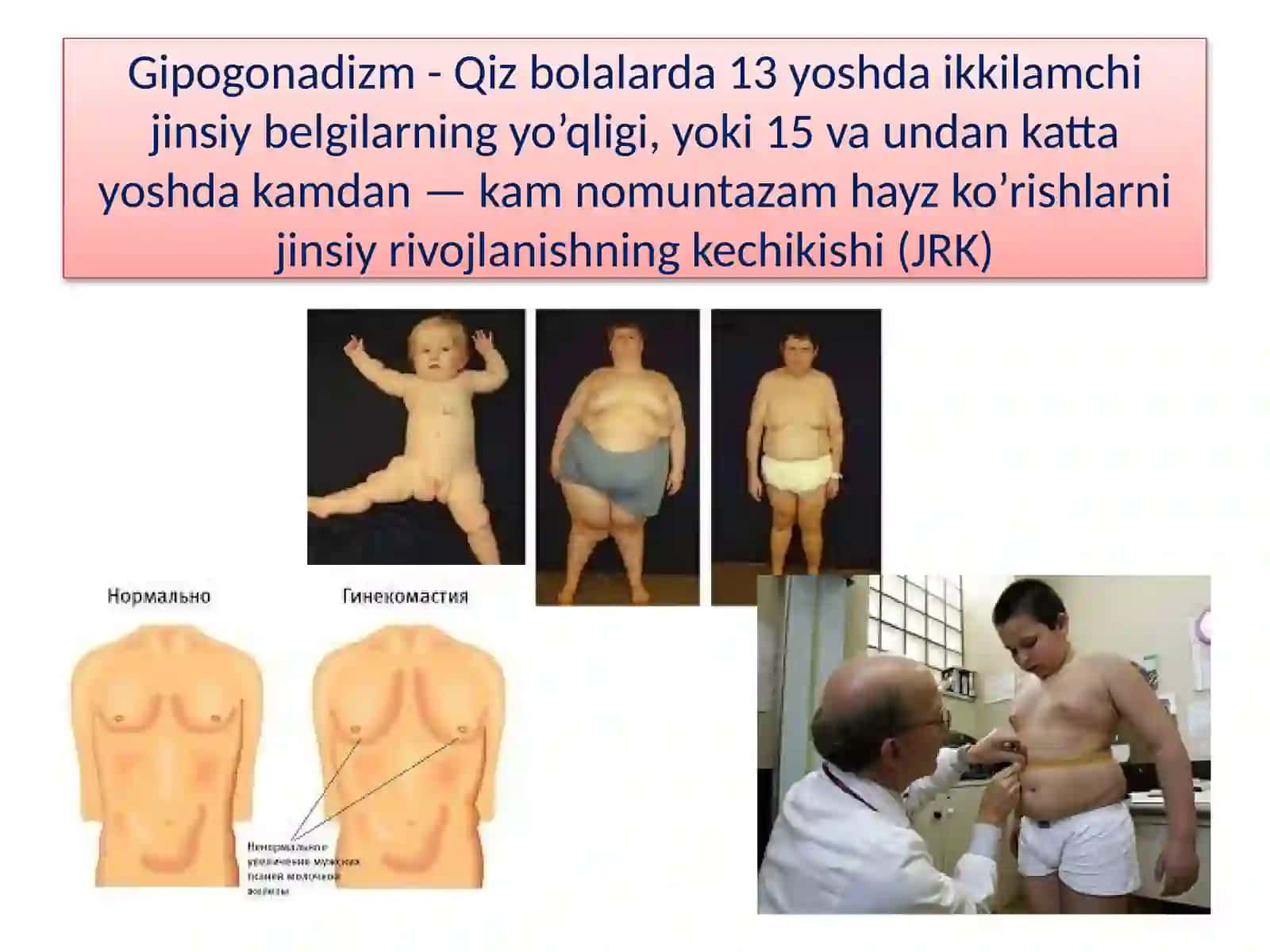 Hypogonadism 2