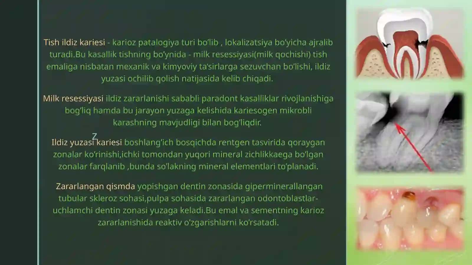 Ildizkariesi,klinikasi,tashxislashvadavolash 2