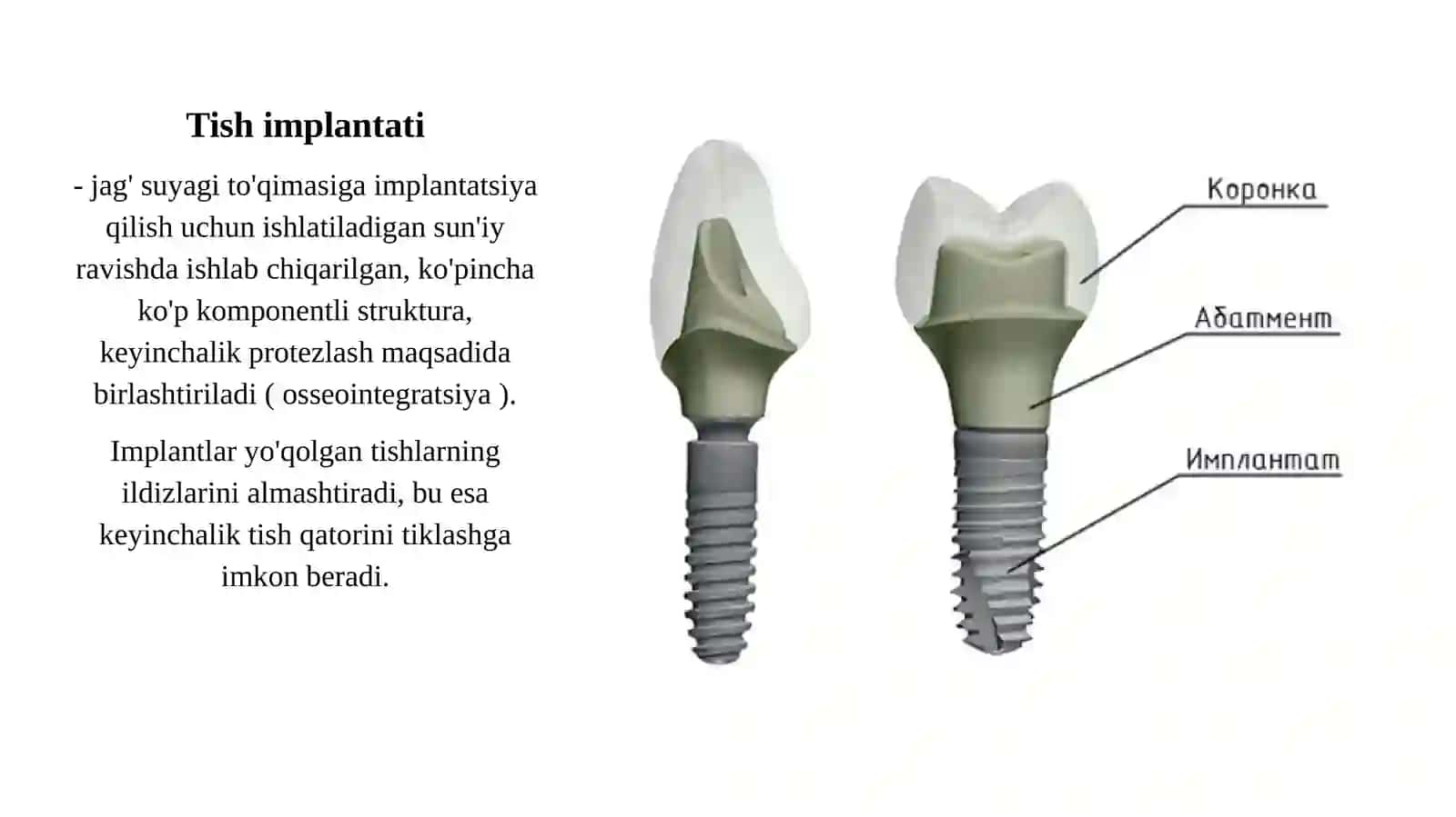 Tishlarning to'liq yo'qolishi holatida implant bilan qo'llab-quvvatlanadigan tish protezlari. 2